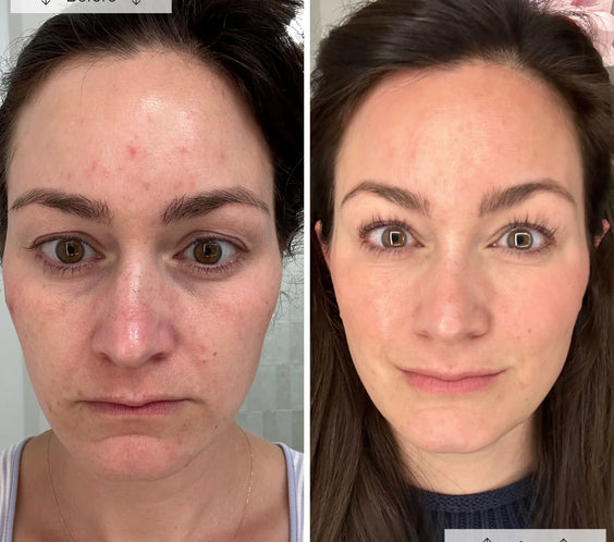 LED Anti-Ageing & Blemish Repair Mask