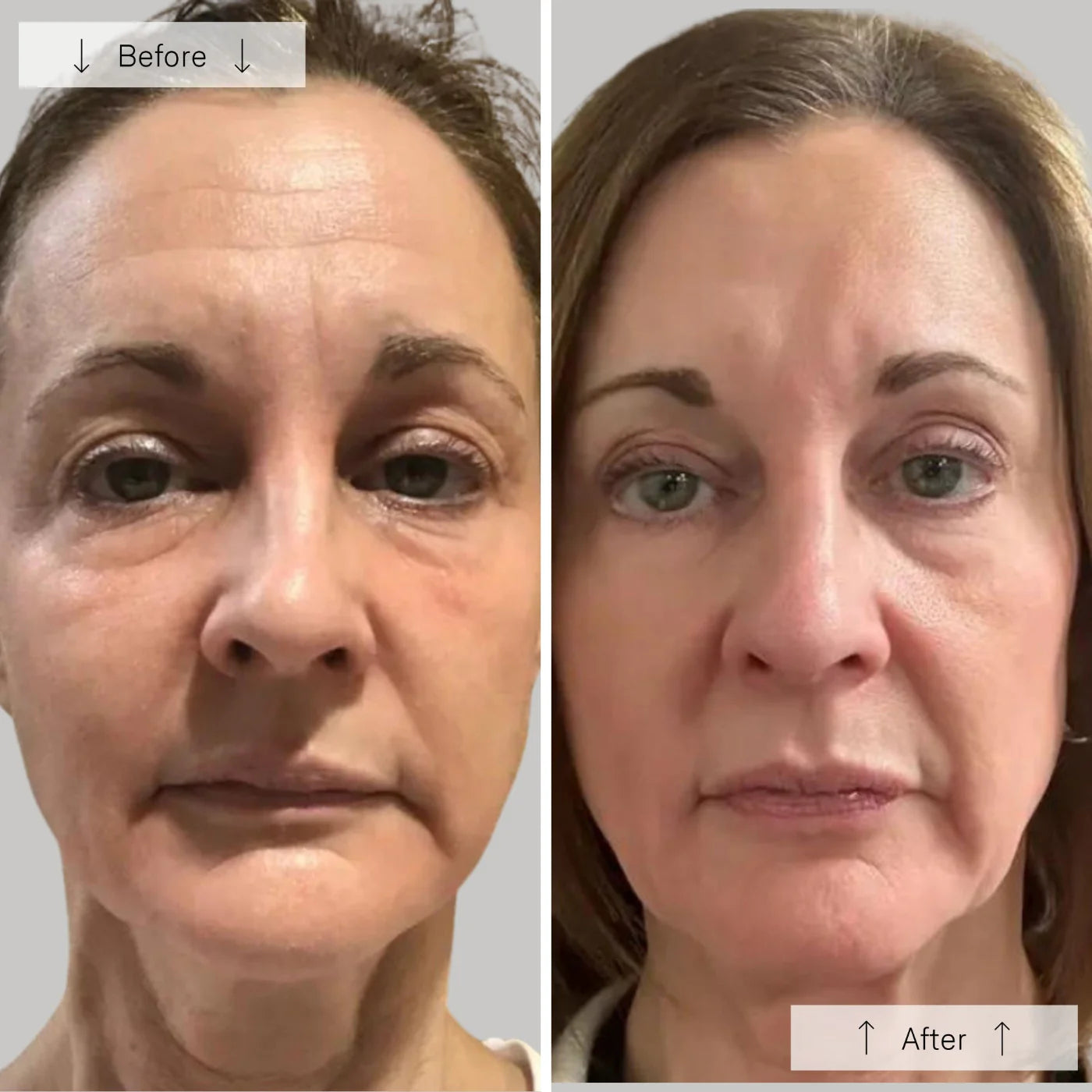 LED Anti-Ageing & Blemish Repair Mask